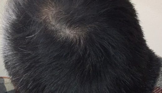 HMENZ育毛ヘアトニックって実際M字ハゲにも効果あるのか使って調べてみた感想。